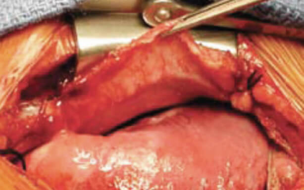 Vascularized native pericardium shown in the remodeled tissue