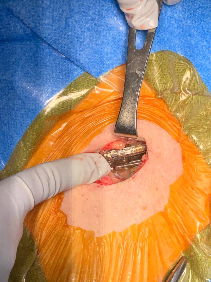 Figure of Cardiac Tissue Repair in donated heart 